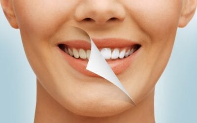 Få et strålende smil: Alt, du behøver at vide om tandblegning!